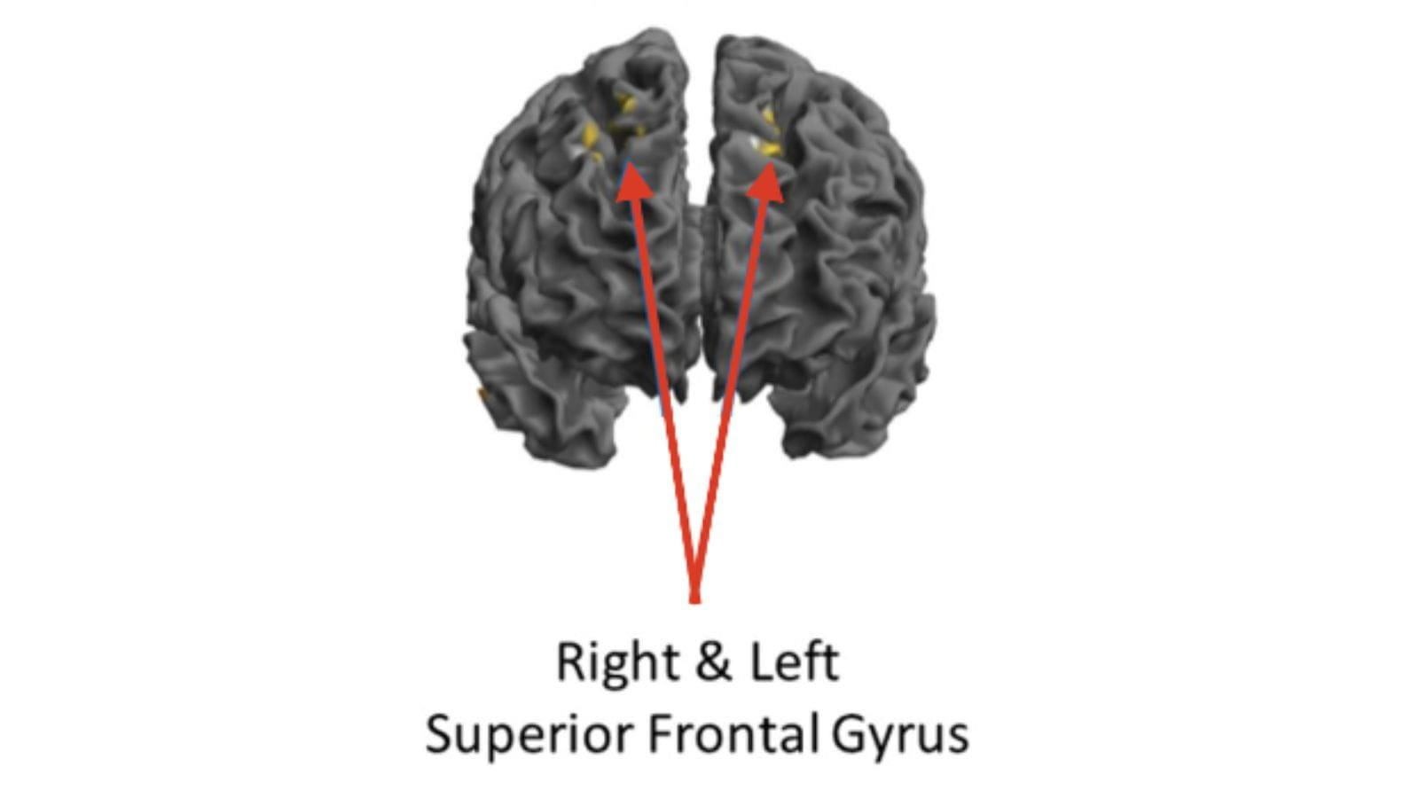Front image of a gray brain with arrows pointing to yellow spots on the right and left superior frontal gyrus