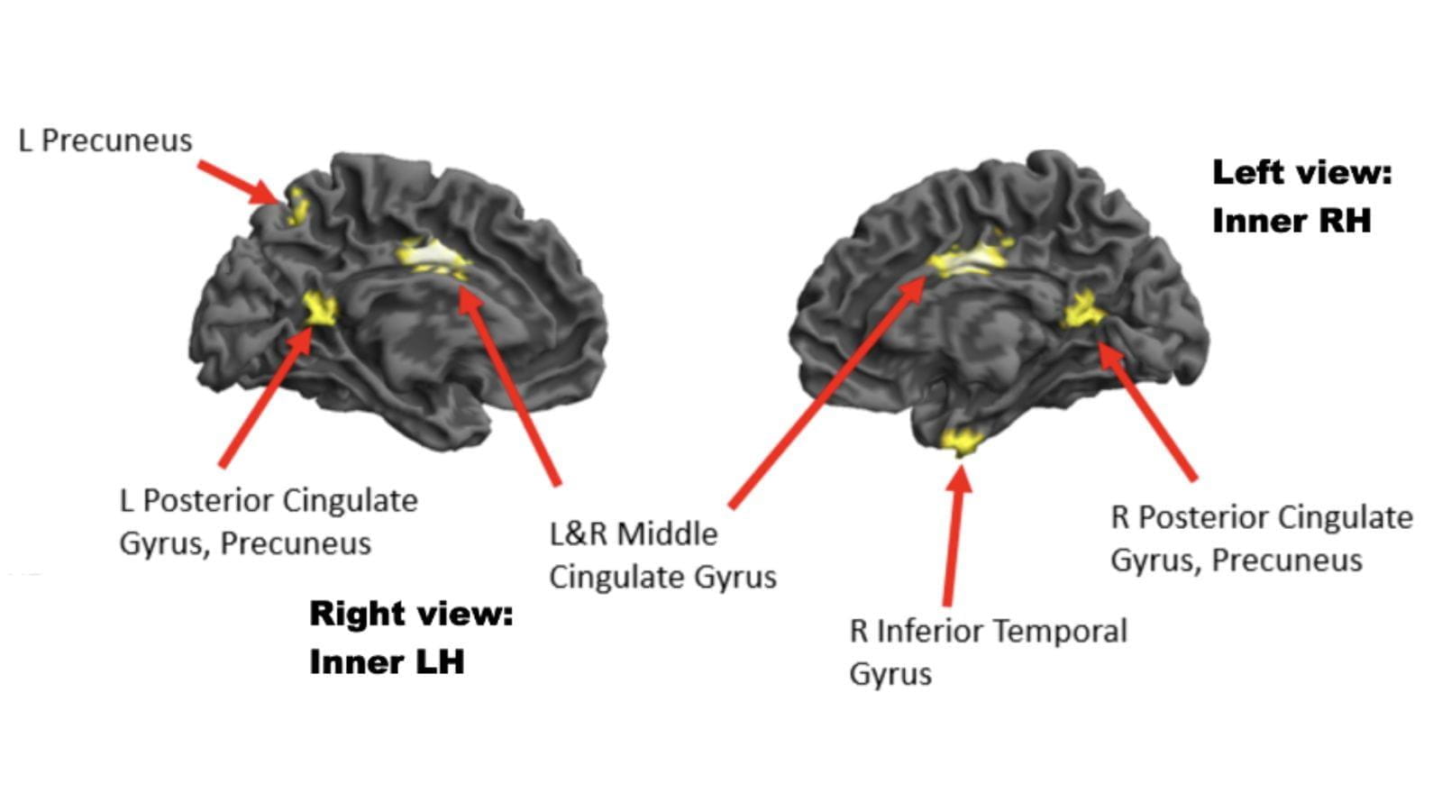 Image of inner views of left and right brain in gray, with arrows pointing to yellow spots showing reduced brain activity.