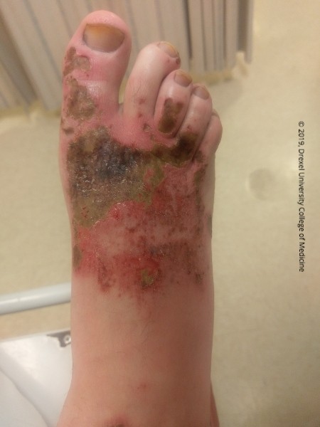 Drexel Toxicology Image Library - Chemical Burns