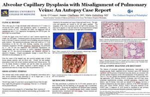 Pathologists' Assistant Research: Alveolar Capillary Dysplasia with Misalignment of Pulmonary Veins