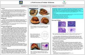 Pathologists' Assistant Research: A Wide Excision of Nodular Melanoma