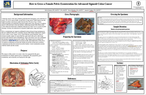 How to Gross a Female Pelvic Exenteration for Advanced Sigmoid Colon Cancer
