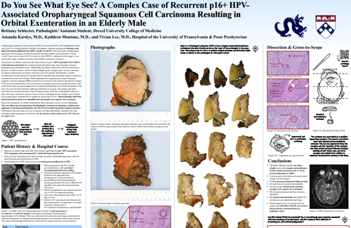 HPV-Associated Oropharyngeal Squamous Cell Carcinoma