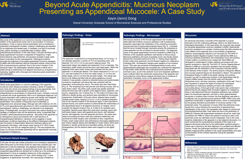 Beyond Acute Appendicitis: Mucinous Neoplasm Presenting as Appendiceal Mucocele: A Case Study