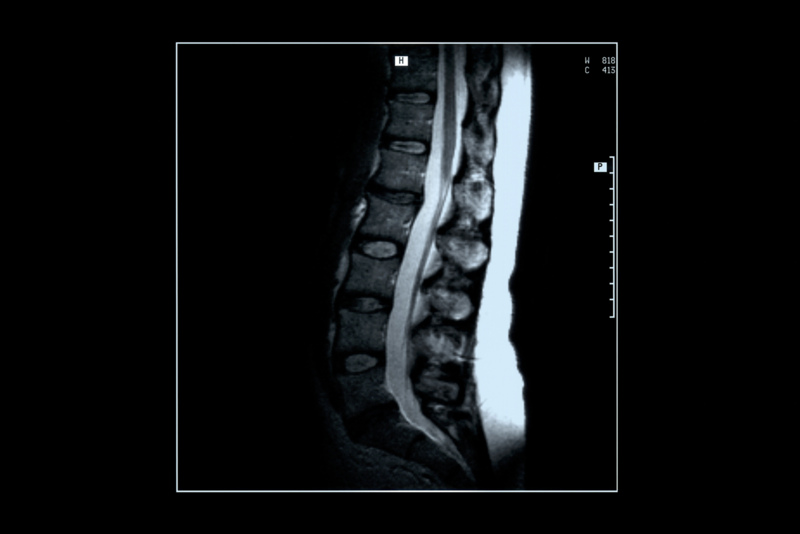 The Latest in Spine Research, Treatments: Experts to Convene at Drexel Symposium