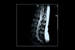 The Latest in Spine Research, Treatments: Experts to Convene at Drexel Symposium