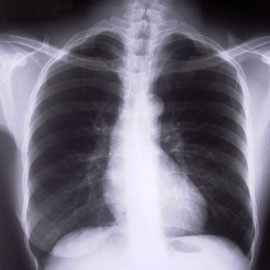 chest xray