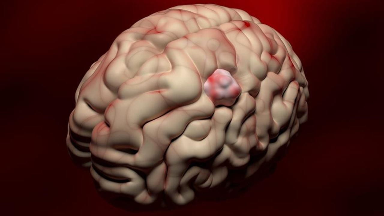 Breast Cancer in the Brain