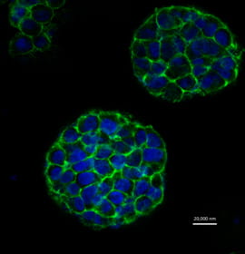 After eight days, the printed mixture of cervical cancer cells and hydrogel grows into living spheroid tumors -shown here with flourescent dye.  