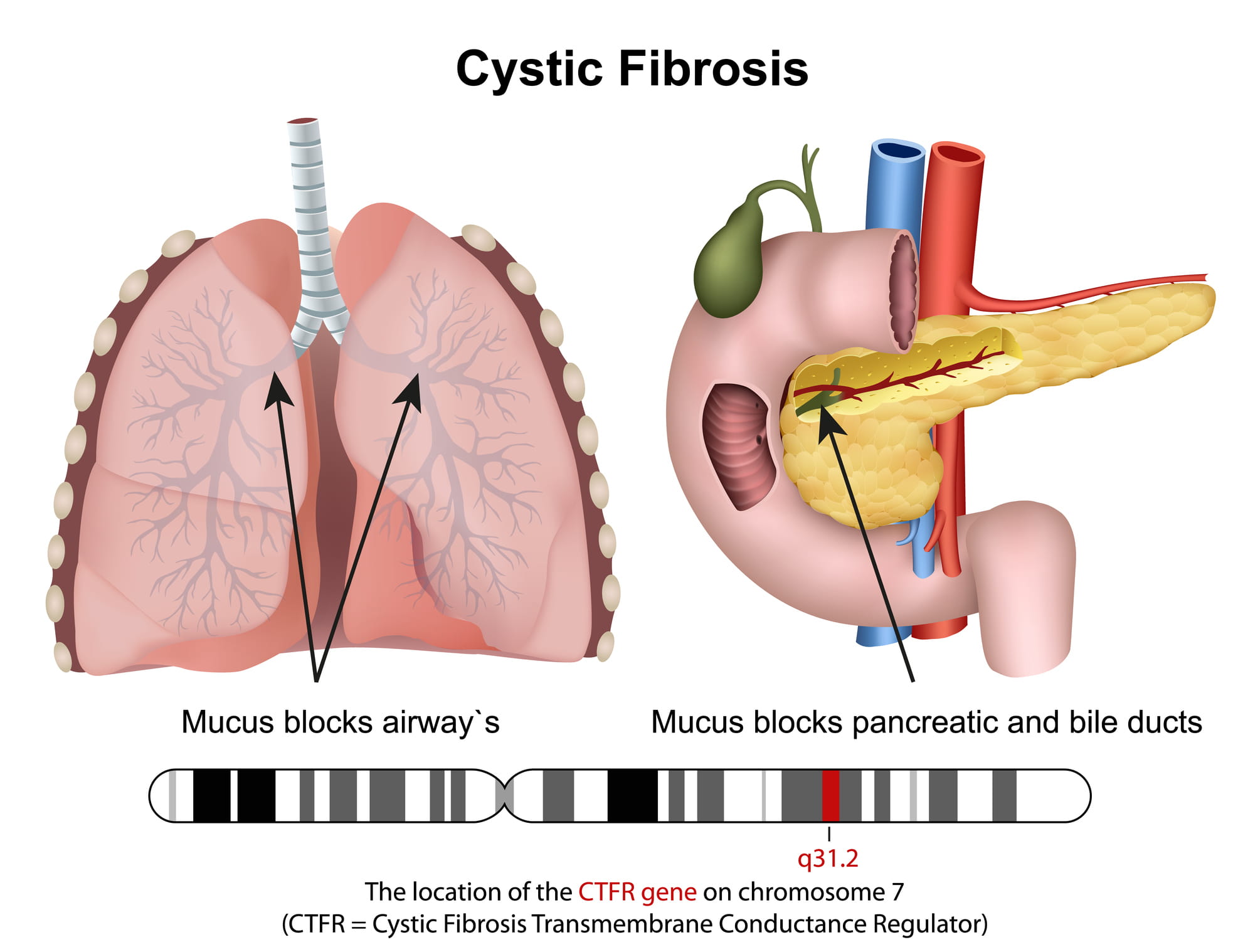 Cystic Fibrosis model