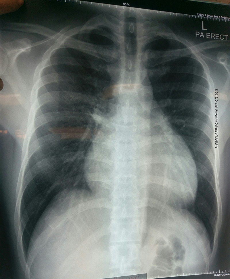 Drexel Toxicology Image Library - Pericardial Effusion Chest x-Ray