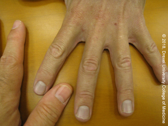 Drexel Toxicology Image Library - Hands affected by ingestion of colloidal silver.