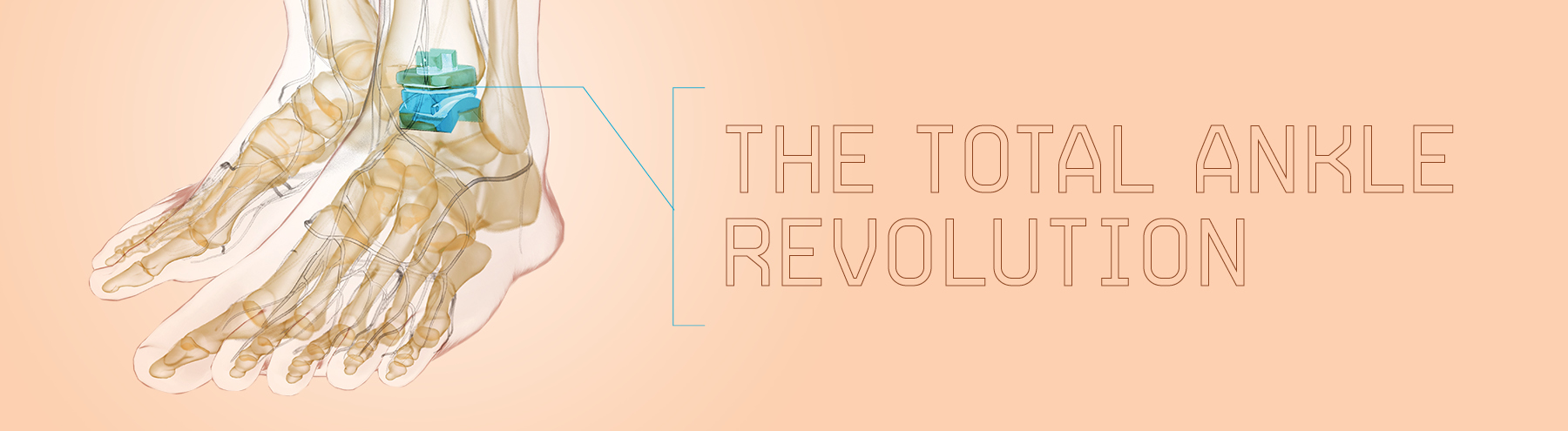 The Total Ankle Revolution