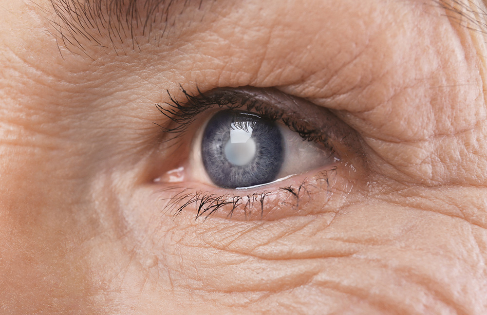 Image of an eye affected by glaucoma.