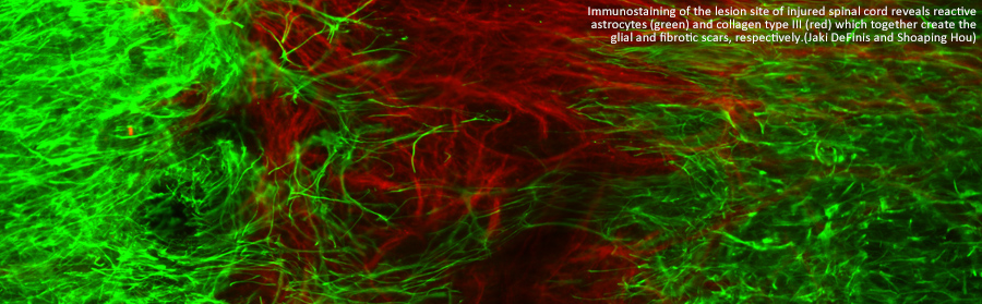 Immunostaining of the lesion site of injured spinal cord reveals reactive astrocytes (green) and collagen type III (red) which together create the glial and fibrotic scars, respectively. (Jaki DeFinis and Shoaping Hou)