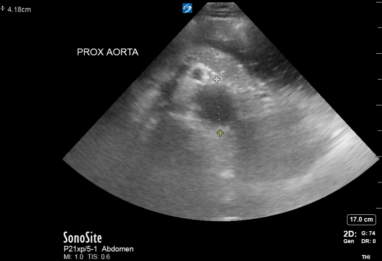 Type A and B aortic dissection and AAA