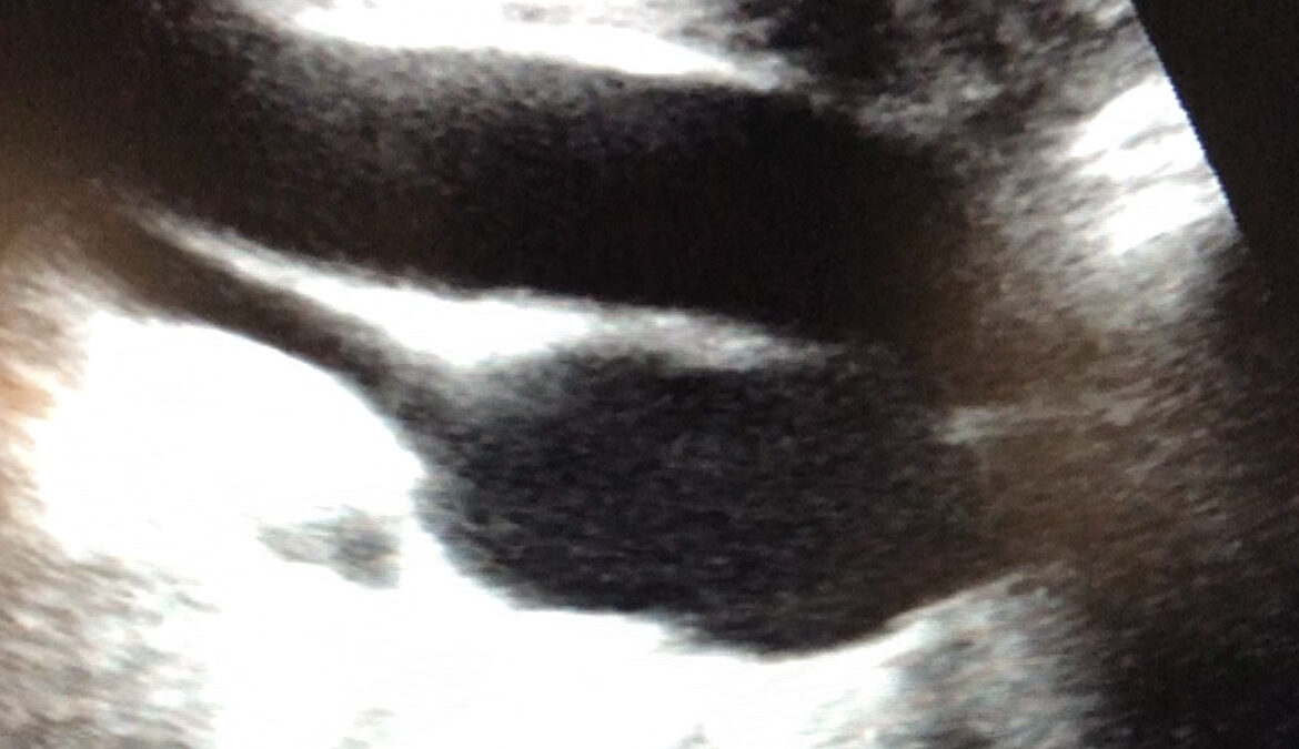 Type A and B aortic dissection and AAA