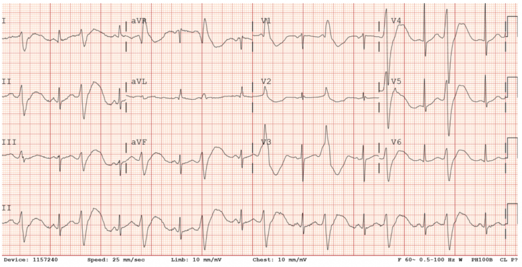 Initial EKG in the ED: Ventricular bigeminy with QTc of 551.