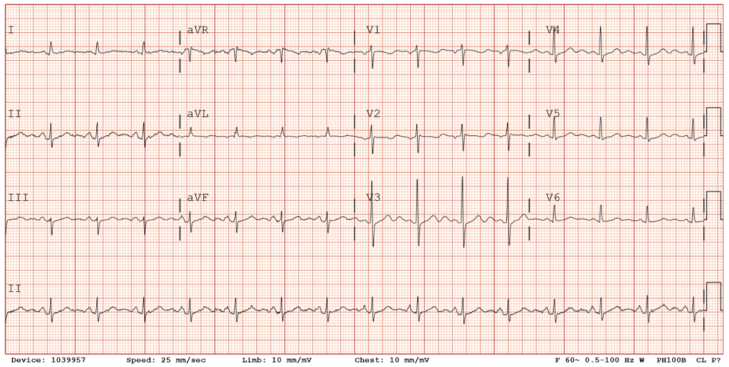 EKG on day of discharge: Normal sinus rhythm.