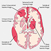 Axial illustration of the brain showing the subtypes of intracranial haemorrhage - Source: (www.bmj.com/content/339/bmj.b2586)