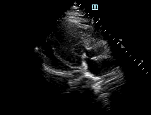 Cardiac Tamponade
