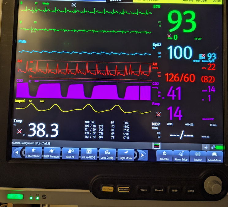 Patient was then transferred to the ICU with fentanyl and propofol for sedation.