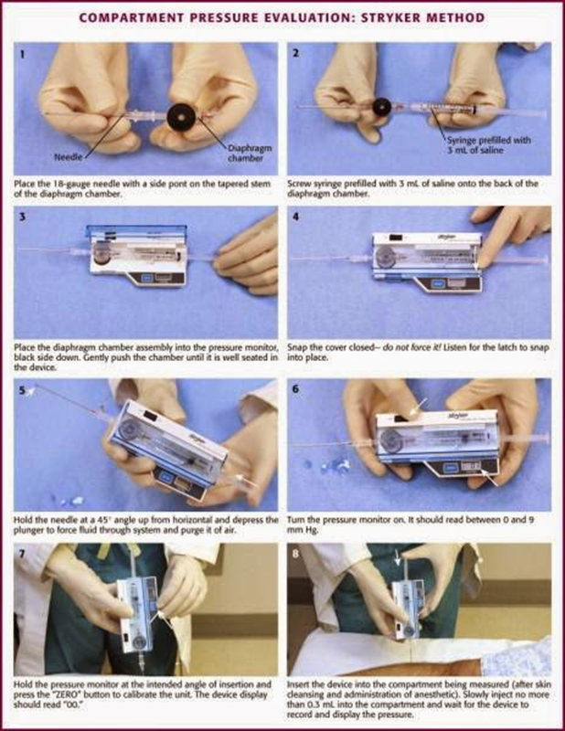 Compartment pressure measurement with Stryker device. This is a great diagram from emcurious.com blog.
