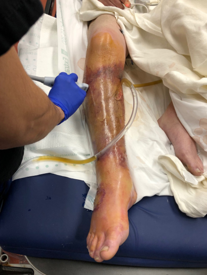RLE below the knee was severely tender to touch and the soft tissue was very tense. (Image Source: Crozer Chester Emergency Medicine Residency)