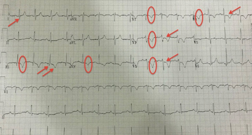 EKG obtained in our case, which you can see has S1Q3T3, simultaneous T wave inversions in inferior and right precordial leads and ST segment depression.