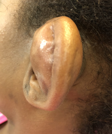 Emergency Med Teaching Case: A Case of Ear Pain and Swelling