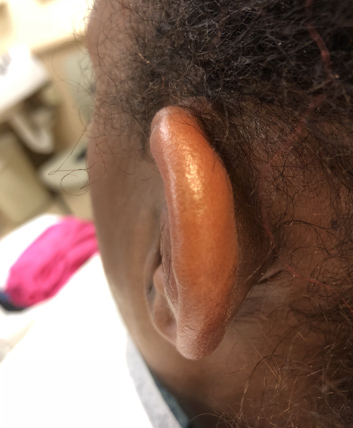Emergency Med Teaching Case: A Case of Ear Pain and Swelling