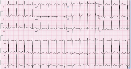 A 66 year-old male presented to emergency department with shortness of breath.