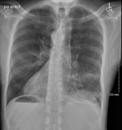 A 66 year-old male presented to emergency department with shortness of breath.