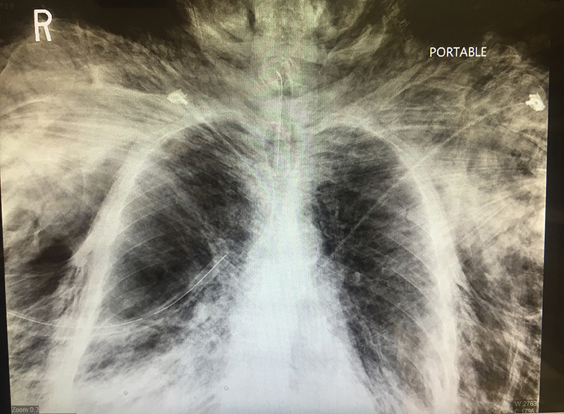 An elderly vent-dependent patient presented to the emergency department with dyspnea, and was found to have a R sided pneumothorax on initial chest x-ray. Source: Drexel Emergency Medicine Blog