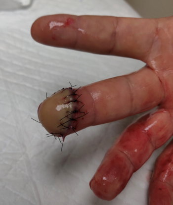 Digit distal amputation: Repaired finger (Image Source: Drexel Emergency Medicine Blog)