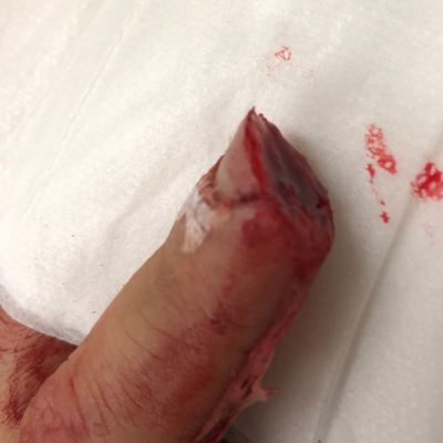 Finger Amputation (Image Source: Drexel Emergency Medicine Blog)