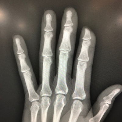 Finger Amputation Xray (Image Source: Drexel Emergency Medicine Blog)