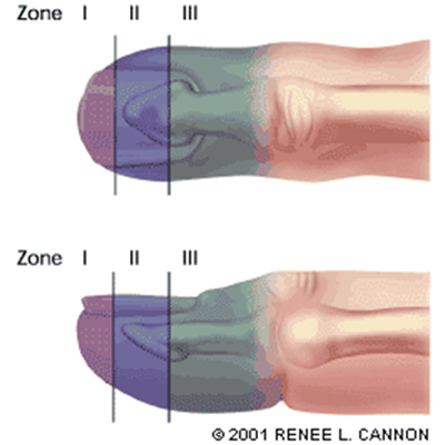Finger Amputation Zones (Image Source: Drexel Emergency Medicine Blog)