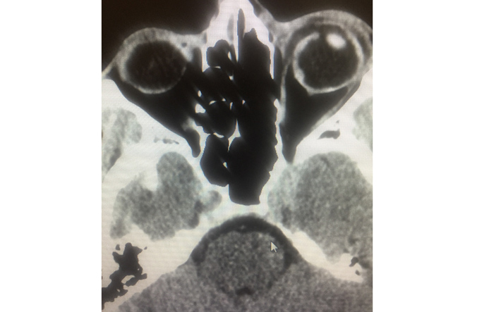 Adult male arrived in the ED by private vehicle with left globe rupture and peri-orbital burns from an exploding firework. One year follow up and patient with partial vision recovery! Source: Drexel Emergency Medicine Blog