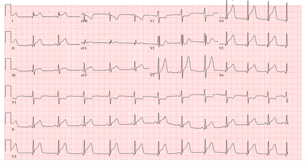 Myopericarditis Initial EKG  (Image Source: Drexel Emergency Medicine Blog)
