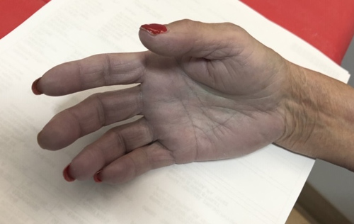 59 yo female with PMH DM/HTN/hypothyroidism and Reynauld’s phenomenon who presented to ED in the morning c/o increasing pain and paresthesia in right hand and it is turning blue since last night.