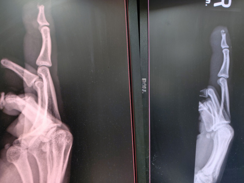 Digit distal amputation: X-ray before (left) and after (right) repair (Image Source: Drexel Emergency Medicine Blog)