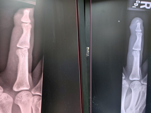 Digit distal amputation: X-ray before (left) and after (right) repair (Image Source: Drexel Emergency Medicine Blog)