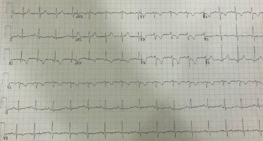 Simultaneously electrocardiogram was obtained demonstrating an S1Q3T3, anterior/septal T wave inversions with depressions in V2-V4.