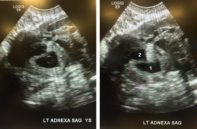 Transvaginal ultrasound revealed a left adnexal mass consistent with a twin ectopic pregnancy. Source: Drexel Emergency Medicine Blog