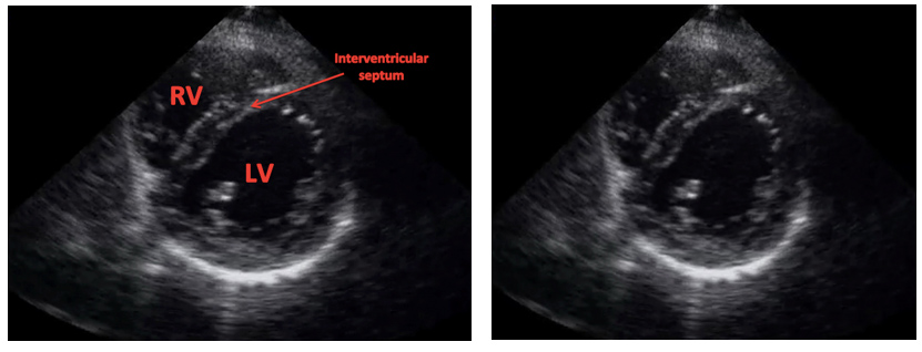 Therefore when viewing the heart in a parasternal short axis during systole the left ventricle maintains a circular appearance, bowing the intraventricular septum into the right ventricle as shown below (image taken from emergencyultrasoundteaching.com).