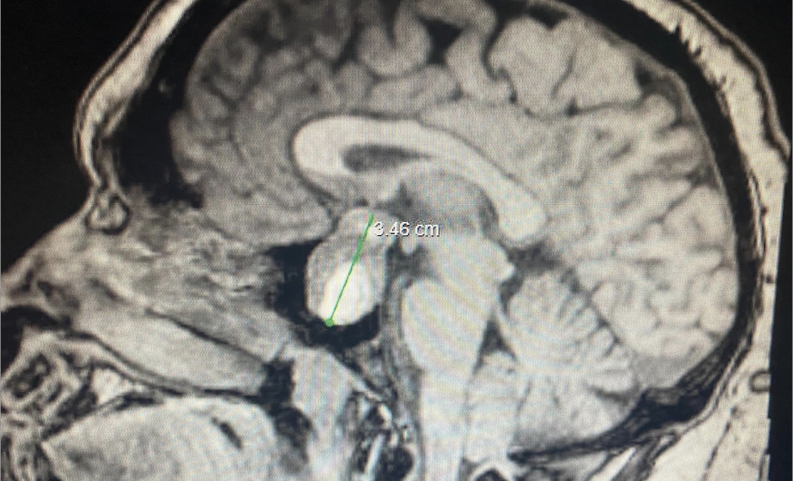 Pituitary Adenoma