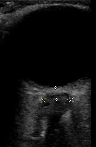 An Ocular Ultrasound was done at bedside in the Emergency Department which showed elevated optic nerve sheath diameter, which was above 5mm bilaterally.