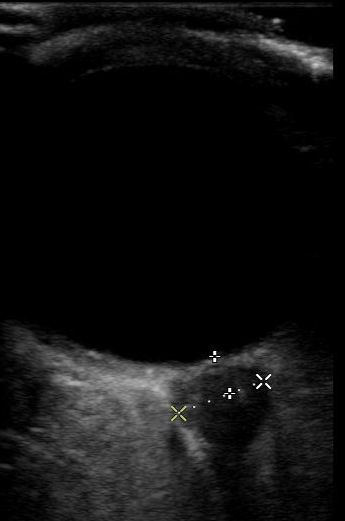 Ocular Ultrasound of Left Eye, Optic Nerve Sheath diameter was 7mm.