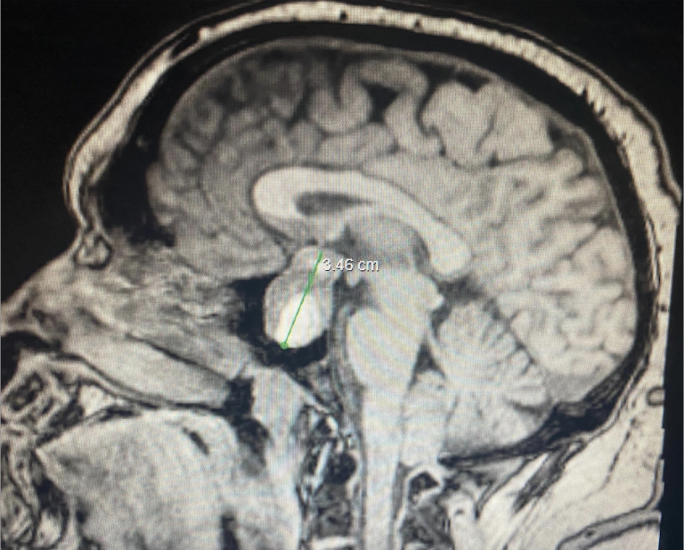 Ocular Ultrasound of Right Eye. Optic Nerve Sheath diameter was 6.9mm.